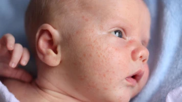 Augmentation des infections au Parvovirus B19: Risques et Précautions à Prendre